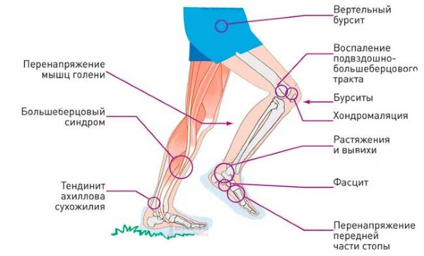 Самые частые травмы у бегунов
