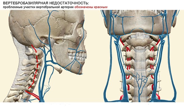 При остеохондрозе происходит сдавливание позвоночной артерии
