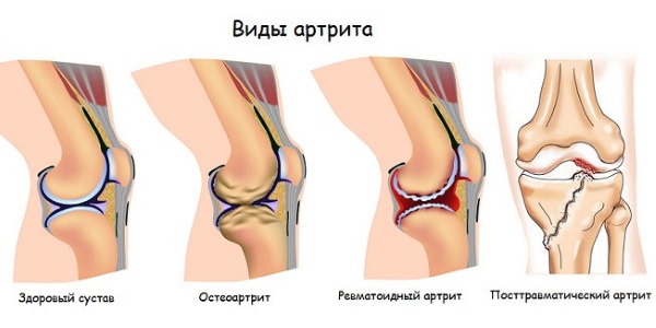 Растительный препарат Алором назначают при различных типах артрита