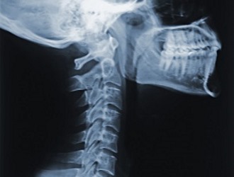 Сглаженный лордоз увеличивает риск защемления нервных окончаний позвоночника