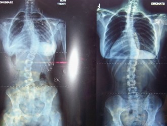 Обратите внимание на основные правила для максимальной эффективности гимнастики Шрот