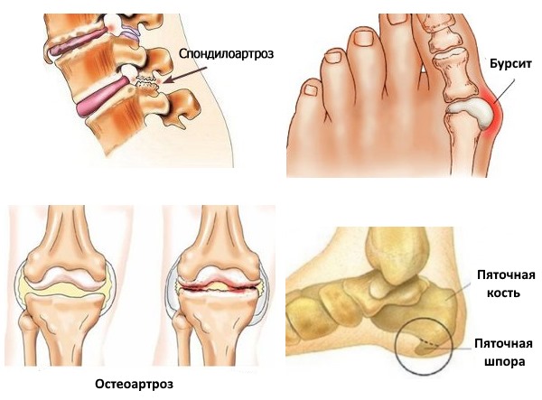 Используется медицинская желчь при заболеваниях опорно-двигательного аппарата