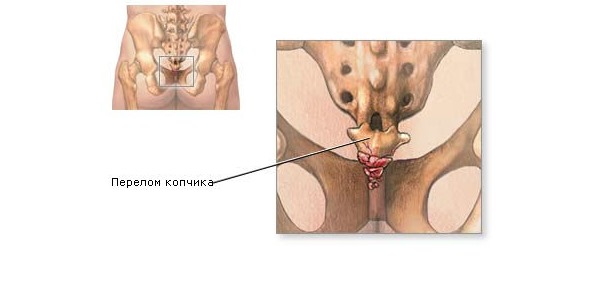 Наиболее частые причины болей в копчике - это травмы