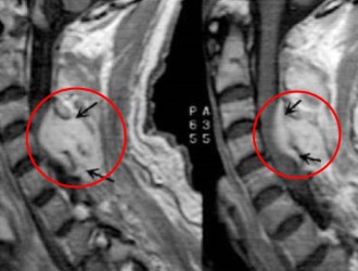 Диагностировать абсцесс спинного мозга можно с помощью МРТ и КТ