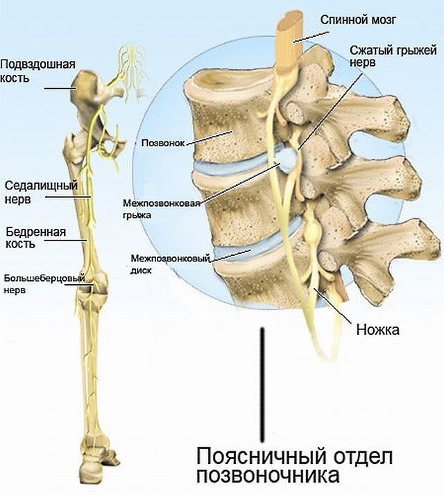 Ниже перечислены основные причины проявления ишиаса