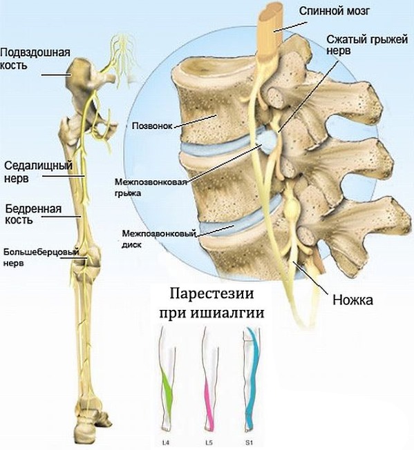 Тринальгин используется для кратковременного лечения ишиалгии