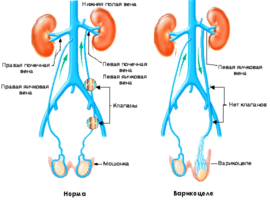сравнение здоровых яичек и с варикоцели