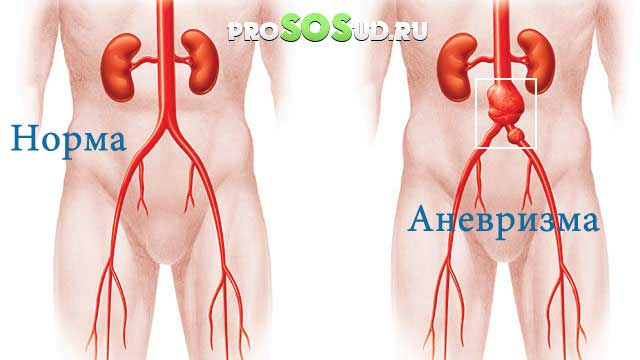 аневризма аорты