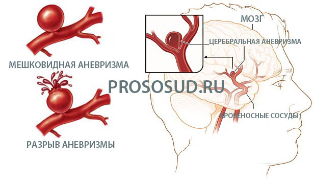 Аневризмы мозга
