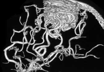 ангиография сосудов головы