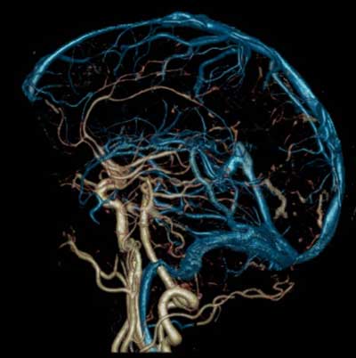 Ангиография головы