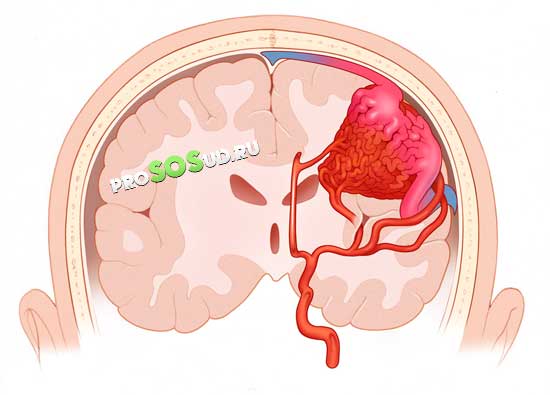 ангиома мозга