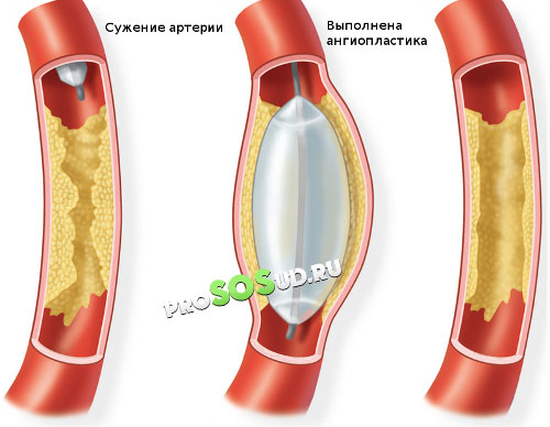 ангиопластика