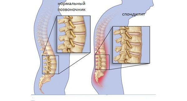 При болезни Бехтерева происходит воспаление суставов позвоночника