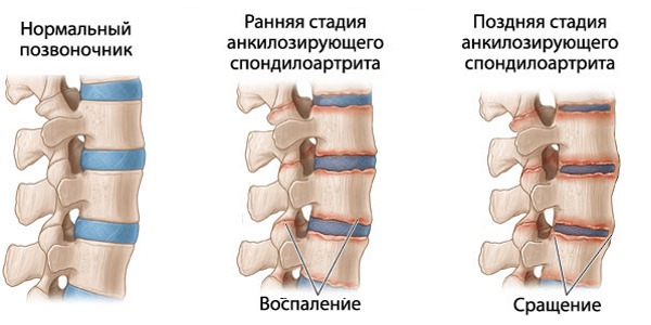 Назначают Новоксикам при спондилите и артрите