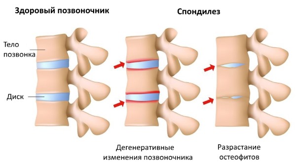 Спондилез возникает при дегенеративных изменениях позвоночника