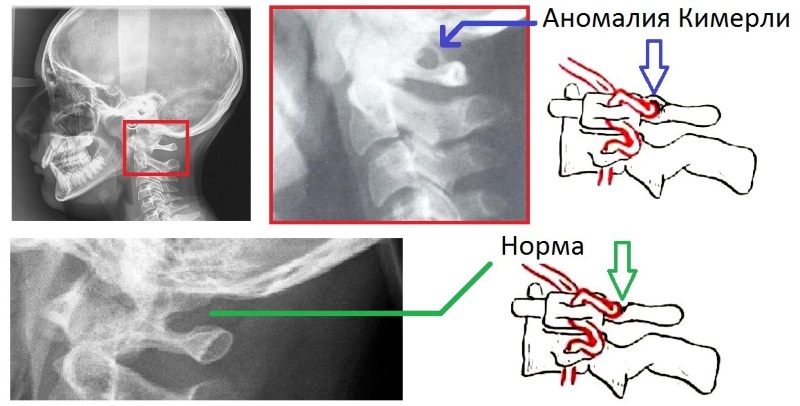 Аномалия Киммерли - патологическое изменение первого шейного позвонока