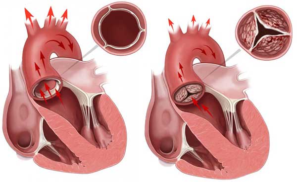 аортальный стеноз