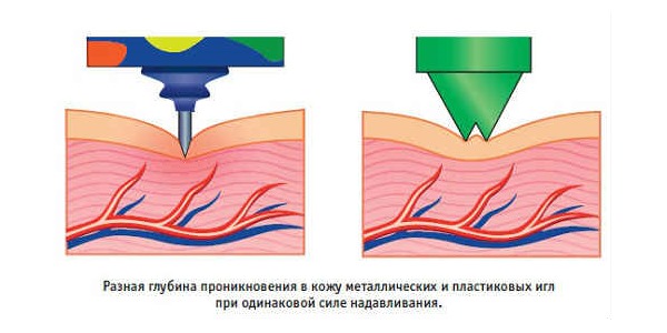 Первоначальный аппликатор Кузнецова был изменен на более щадящую версию