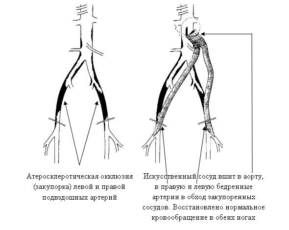 искуственный сосуд вшит в артерию