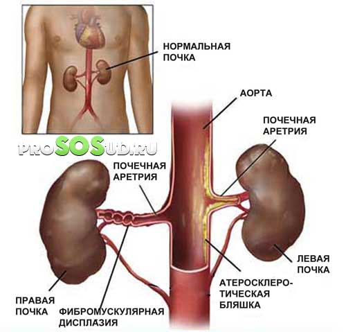 артерии почек