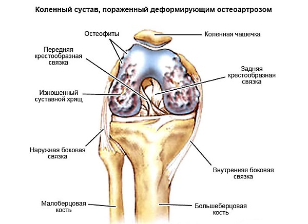 Деформирующий остеоартроз - одно из основных показаний к использованию Целебрекса