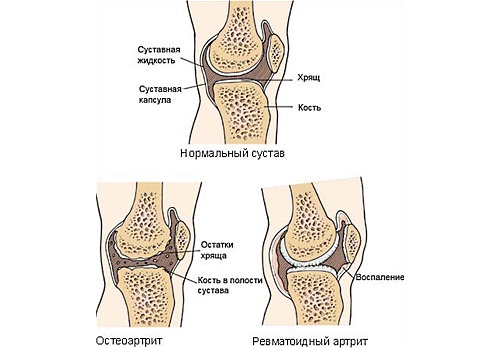 Используют Нурофен Экспресс при различных суставных болях