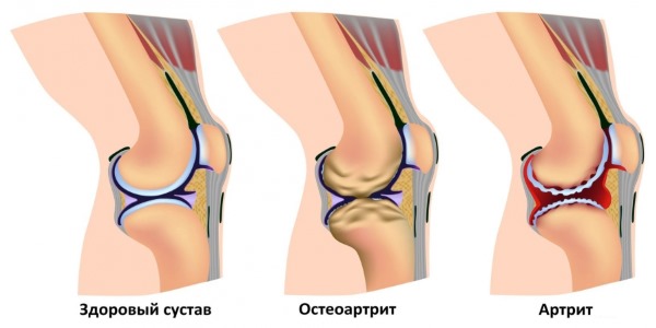 Лечат с помощью Дилаксы артрит, остеоартрит и болевые синдромы в суставах