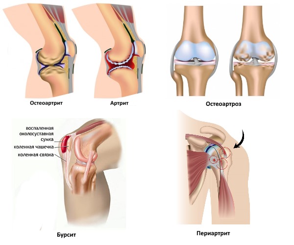 Обратите внимание при каких заболеваниях применяют гель Кетонал