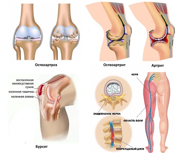 Кетонал в виде крема и геля преимущественно назначают при дегенеративных нарушениях суставов