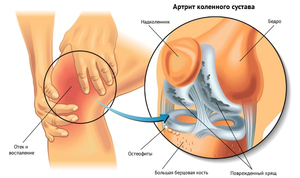 Для лечения артрита и других суставных заболеваний используют 20% Биопин
