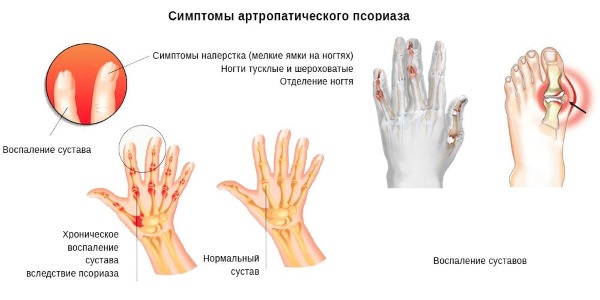 Фламадекс используется при воспалительных заболеваниях, таких как псориатический артрит