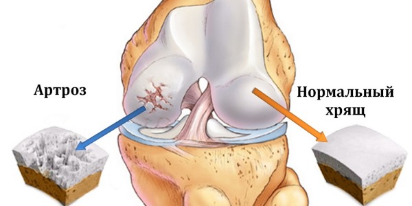 Операцию при артрозе необходимо делать как только появляется невыносимая боль в суставах