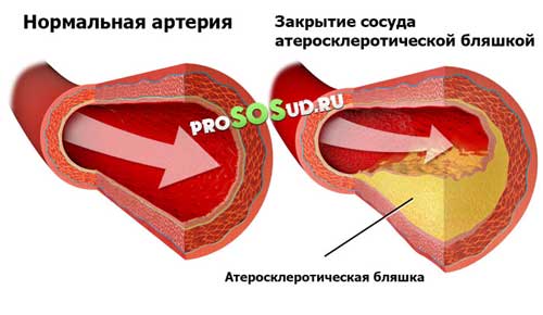 атеросклеротическая бляшка