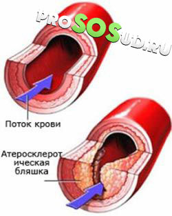атеросклероз в сосудах