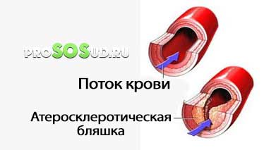 атеросклеротическая бляшка
