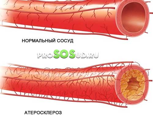 атеросклероз