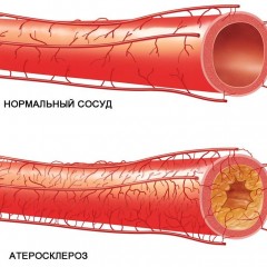 атеросклероз