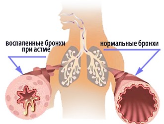 При бронхиальной астме противопоказано использовать НПВС