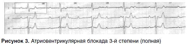 атриовентрикулярная блокада сердца 3 степени