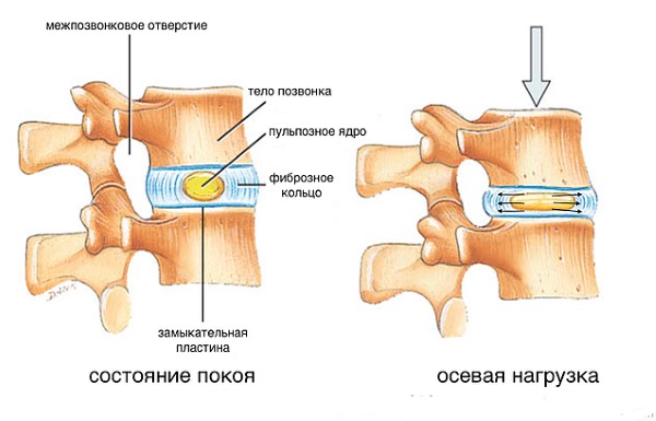 Хондроз проявляется в следствии ухудшения питания хрящевой ткани и нагрузки на позвоночник, что вызывает разрушение дисков