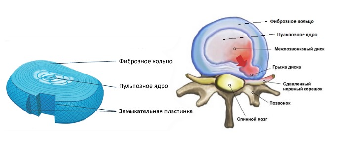 Межпозвоночная грыжа возникает, когда фиброзное кольцо не в состоянии удерживать пульпозное ядро, в следствии чего второе выпадает в позвоночный канал