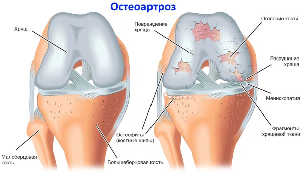Показанием к приему препарата Артродарин является остеоартроз