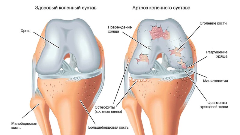 Назначение Кондроновы оправдано при артрозе суставов