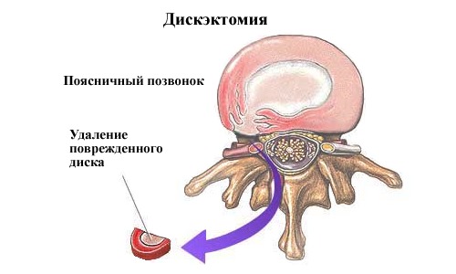 Операционное лечение грыжи подразумевает частичное или полное удаление диска позвонков