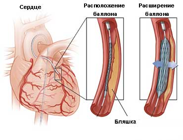баллонная ангиопластика