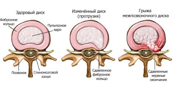 Используют Карипаин при грыжах позвоночника до 3 мм