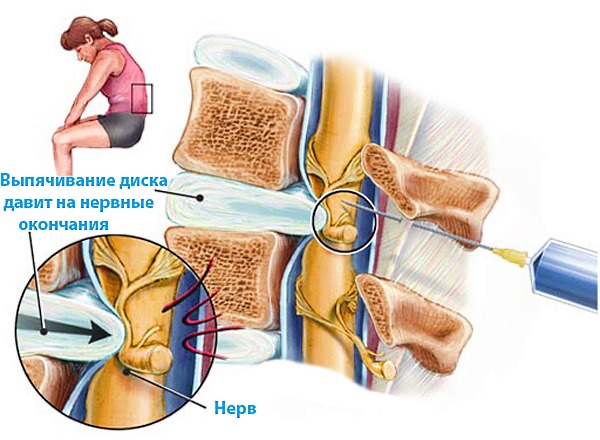 При сильных болях в спине в пораженную область вводят блокаду