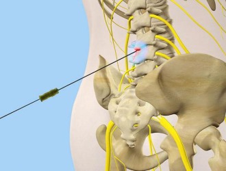 При болях в спине применяются различные блокады