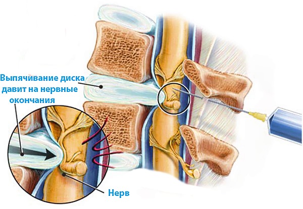 Метод блокады болевого синдрома при ущемлении нерва